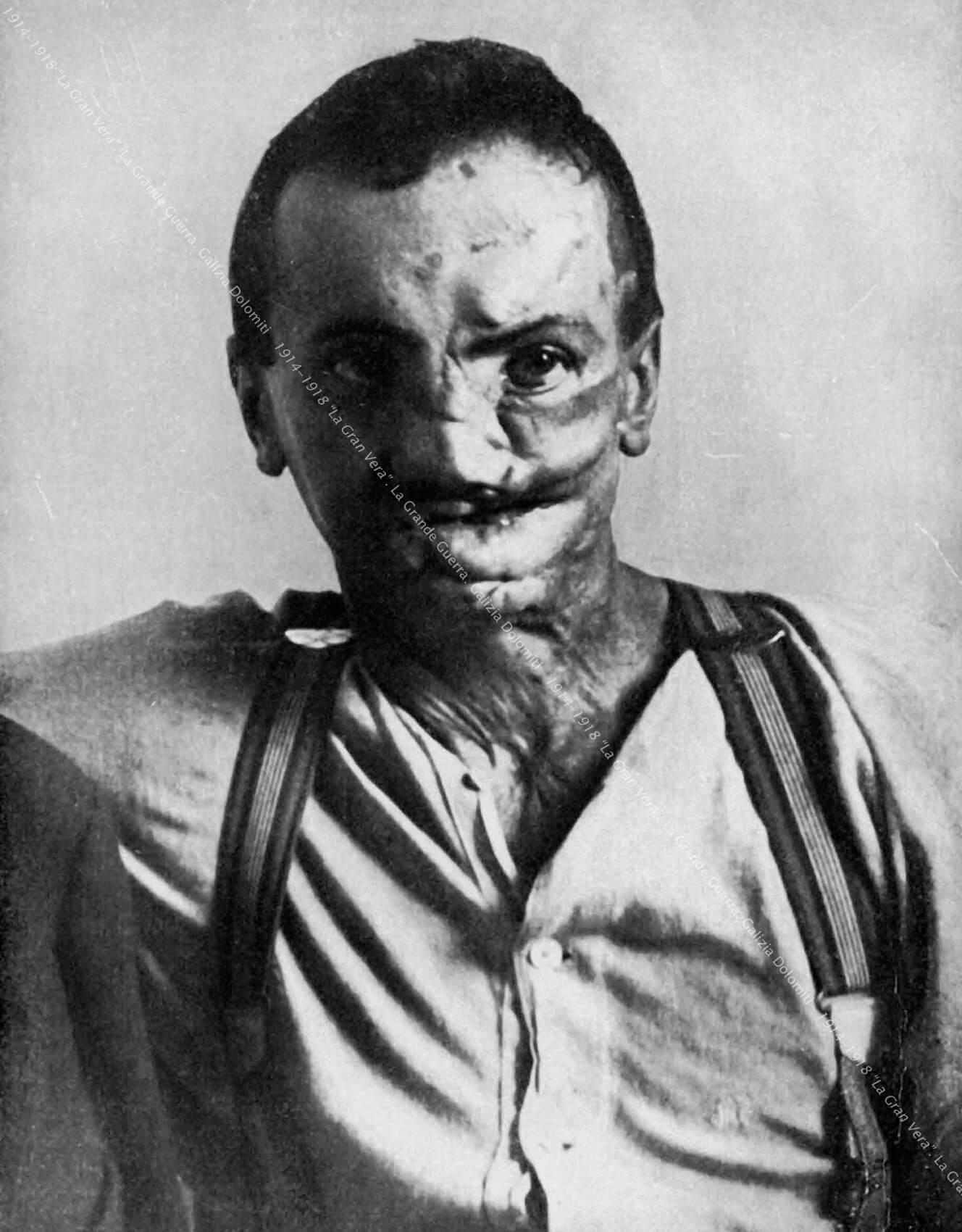 A 25-year-old peasant, wounded by grenade shards in 1916
